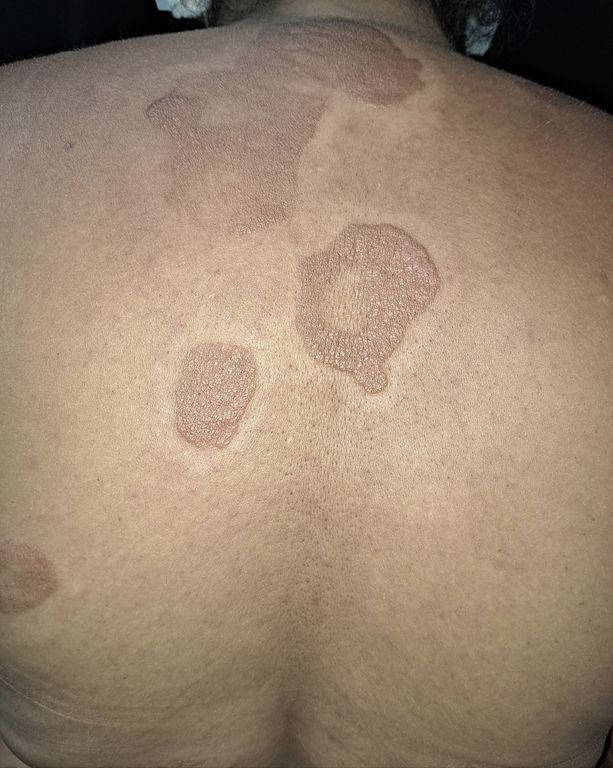 Enfermedad de Hansen / Lepra: Lo que necesitas saber en palabras sencillas