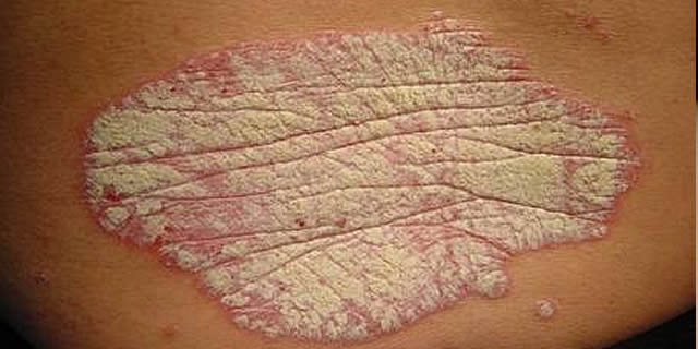 Psoriasis
